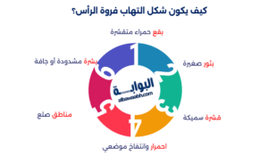 أكزيما فروة الرأس