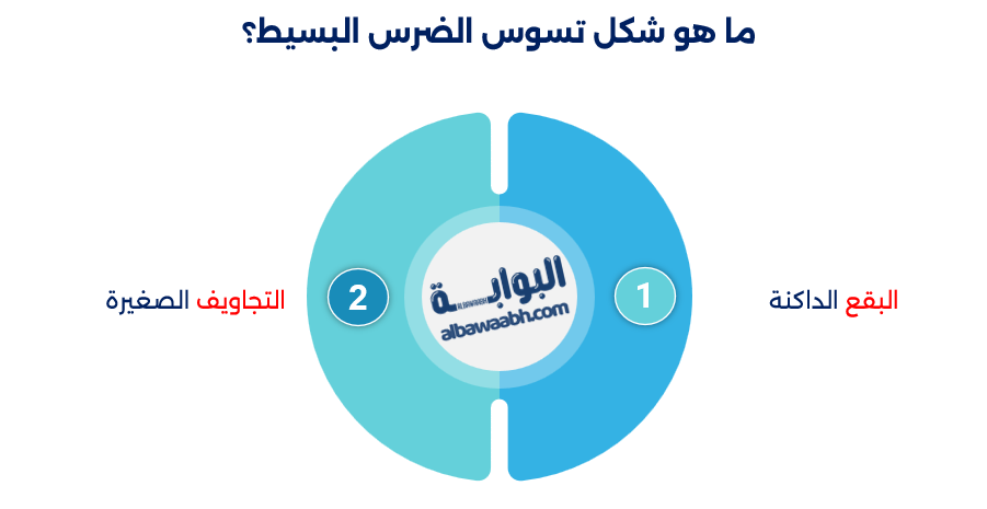 أنواع تسوس الأسنان