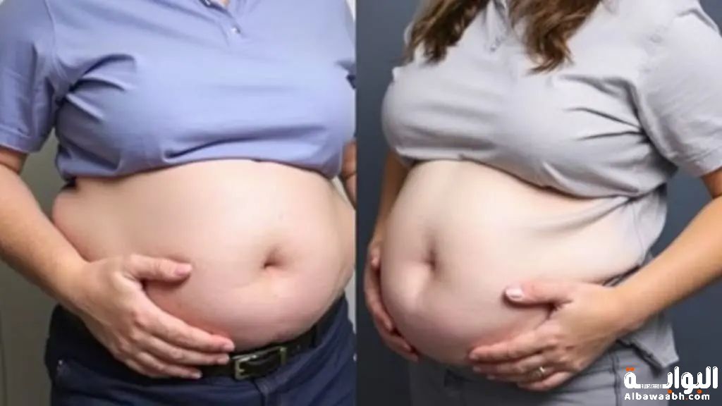 حكم عملية تكميم المعدة