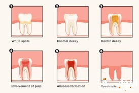 أنواع تسوس الأسنان