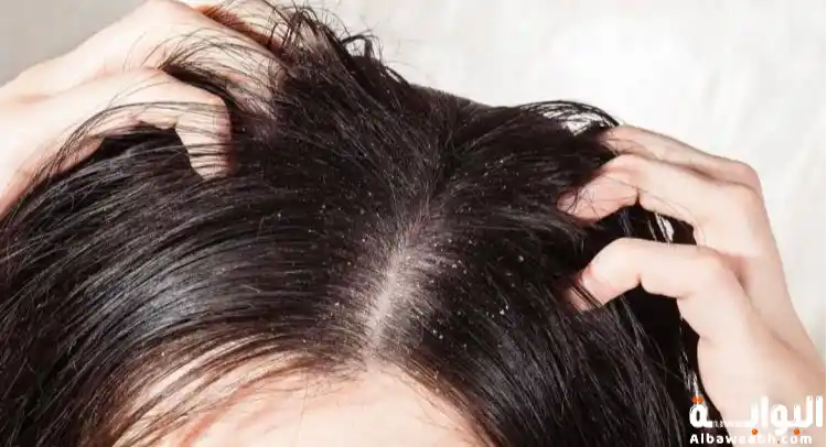 تفسير حلم نزع القمل من الشعر للعزباء