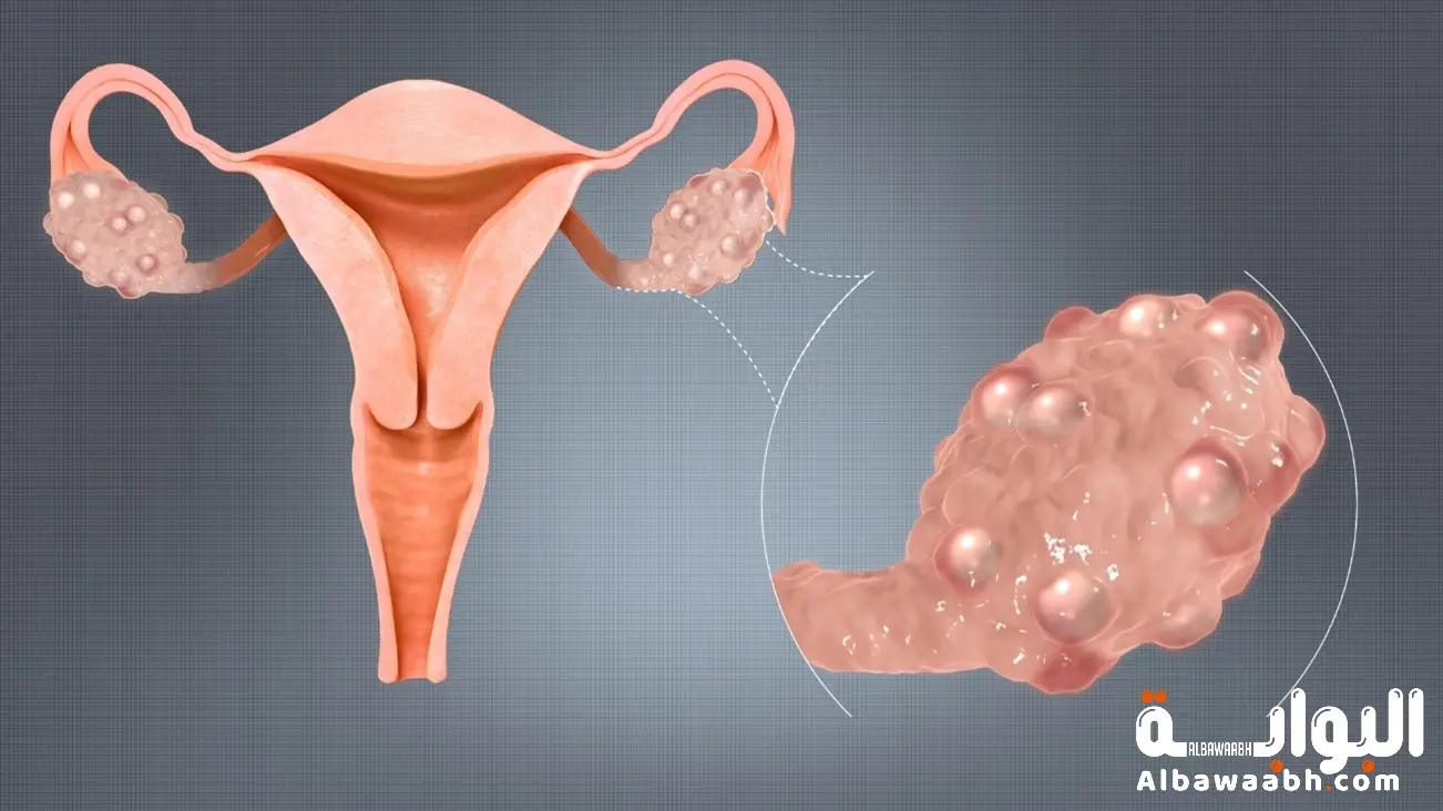 أسباب تكيس المبايض عند الفتيات تحت 30 سنة