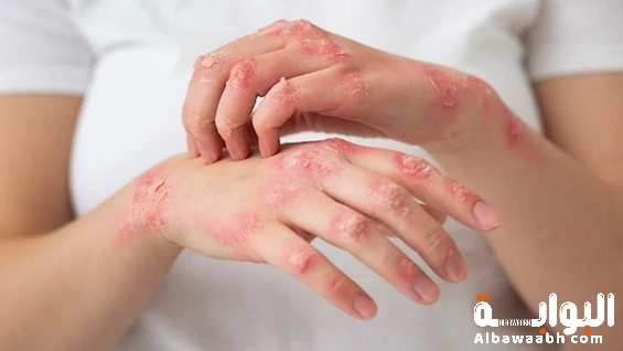 أفضل طرق علاج الصدفية في المنزل بالأعشاب