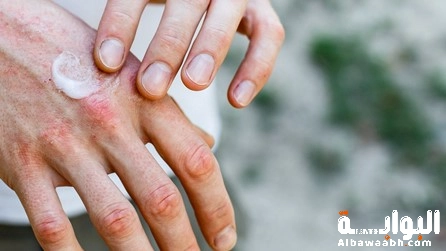 علاج تشققات الجلد في الكعبين واليدين في الشتاء
