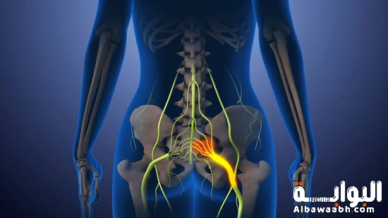علاج عرق النسا (العصب الوركي) في المنزل بدون جراحة